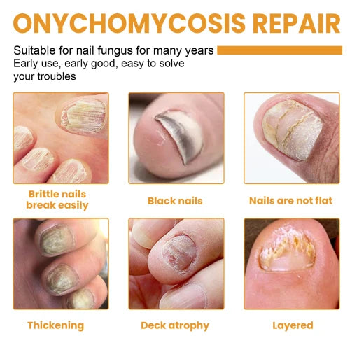 Ximonth Fungal Patches  Repair Thickening Grey Soft Shine Nail Care Patch